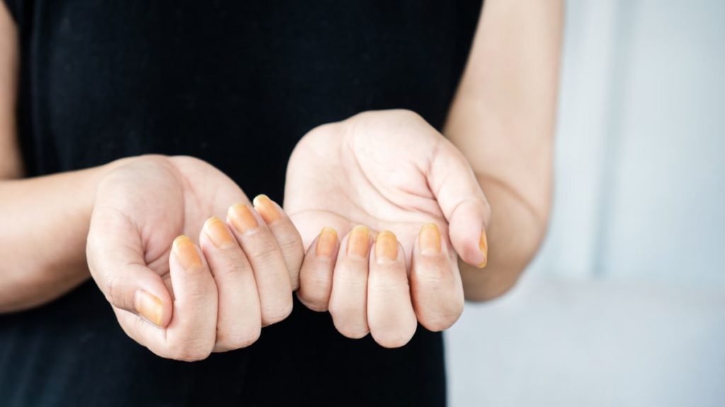 The Nail Cosmetics Allergy Epidemics How can Nail Varnish harm you