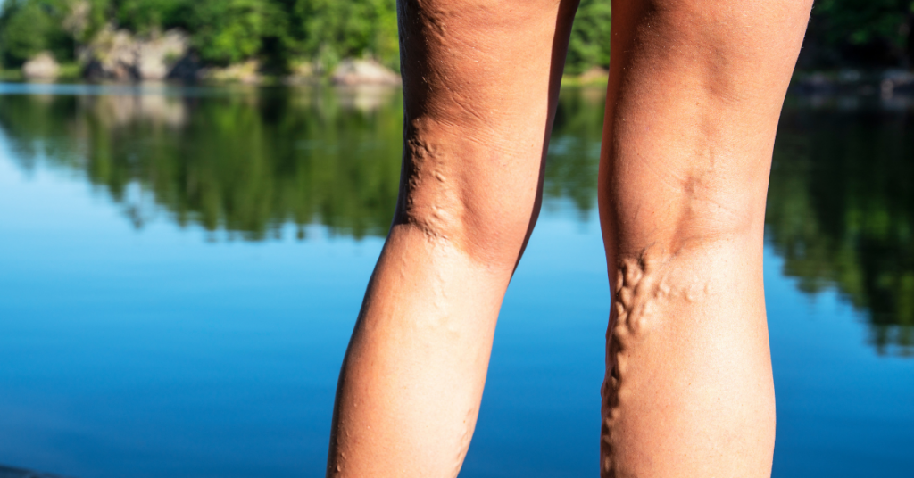 Varicose veins affecting the leg of an elderly man - Stock Image