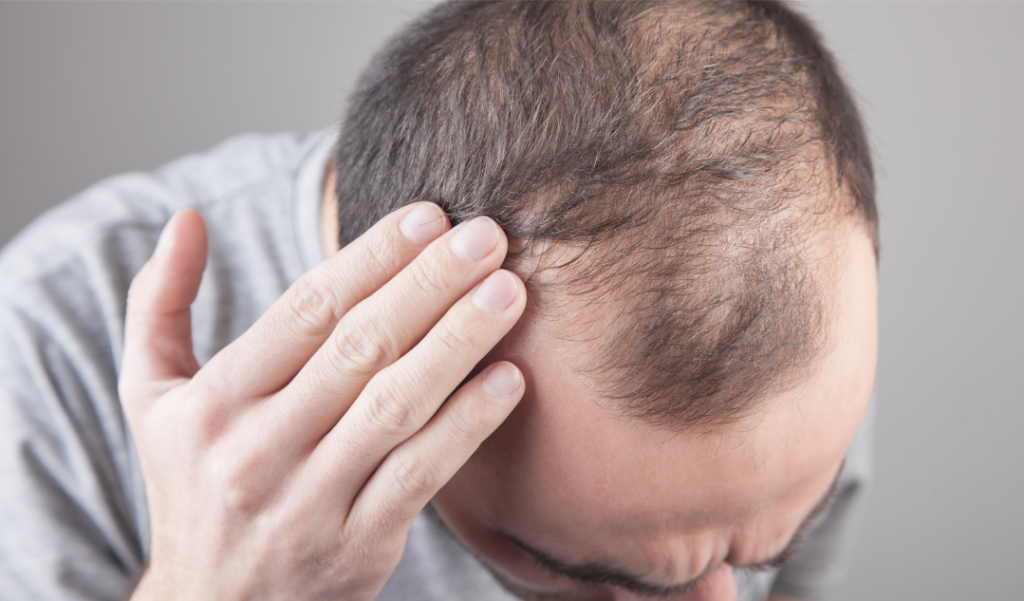 How do men feel about hair loss?